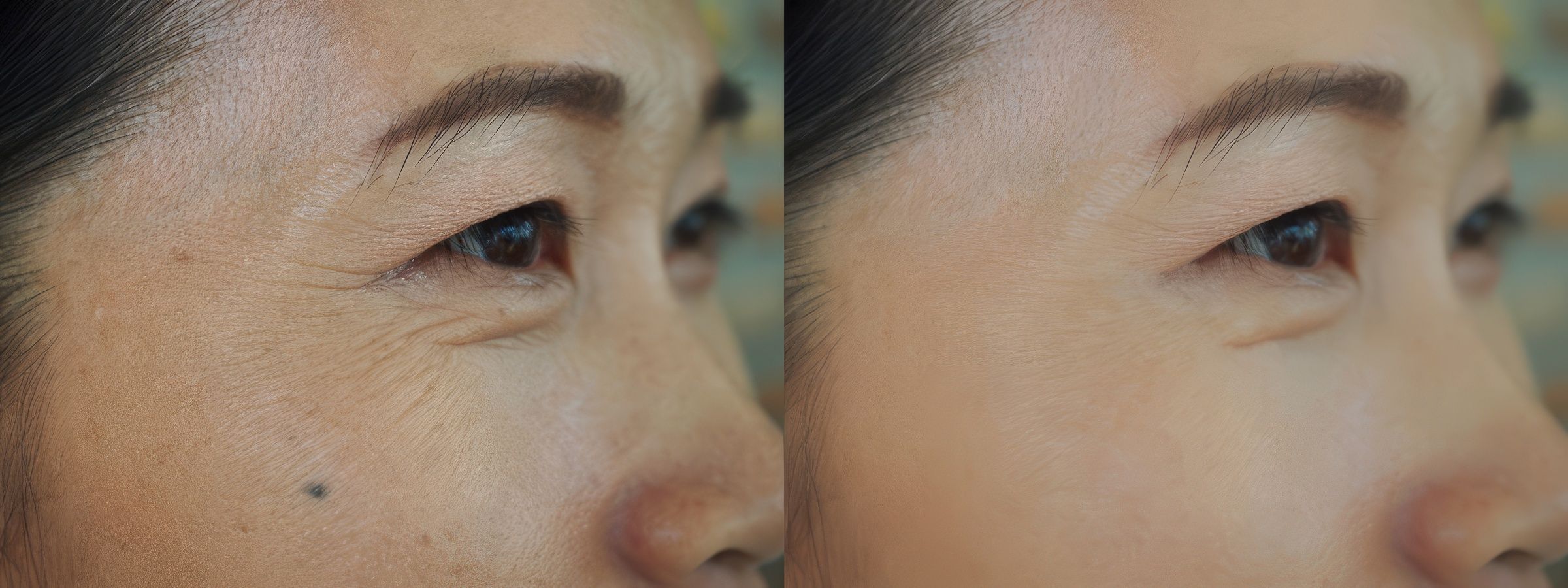 Ảnh Before - After của khách hàng đã điều trị bằng Exilis Ultra 360