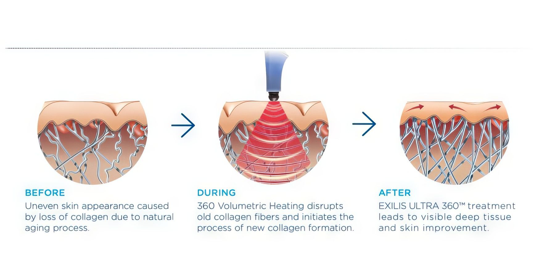 Exilis Ultra 360 - Giải mã sức mạnh hồi sinh làn da