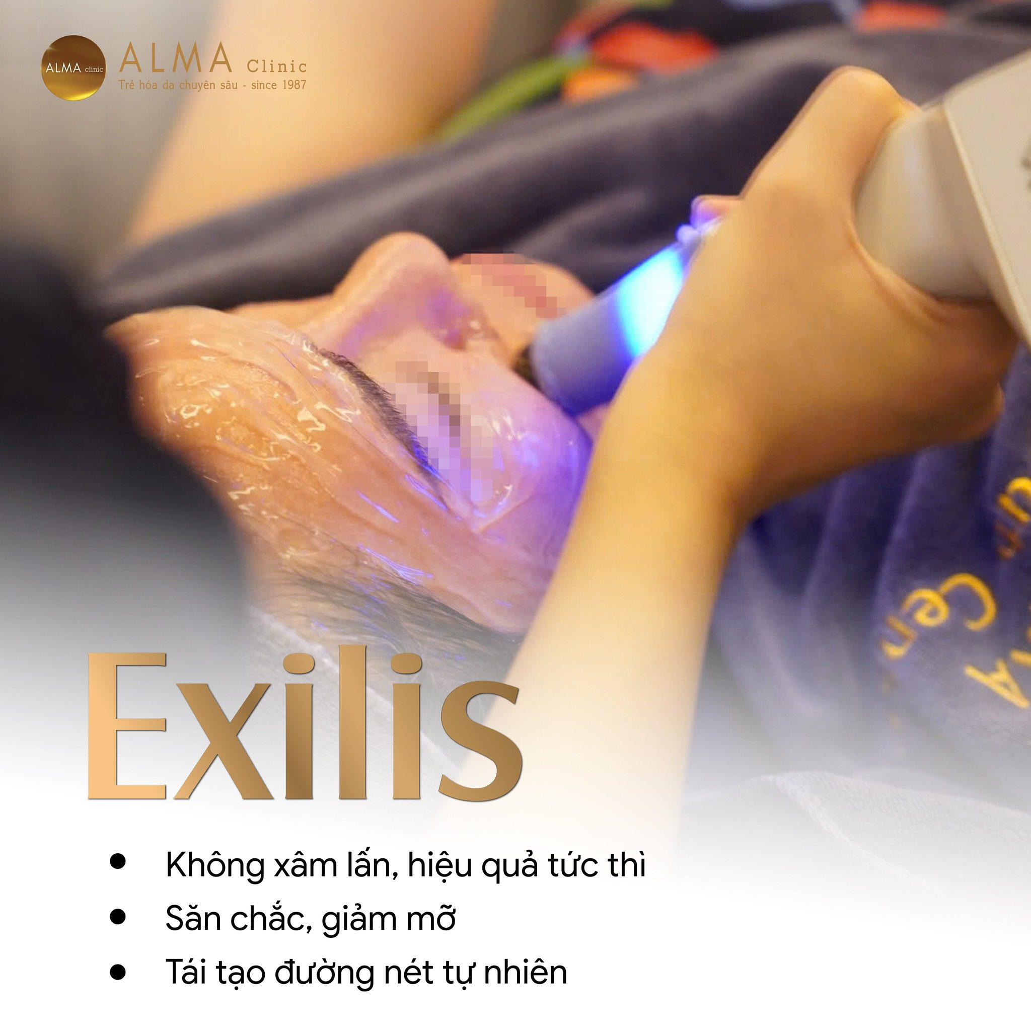 Exilis Ultra 360 của Alma Clinic
