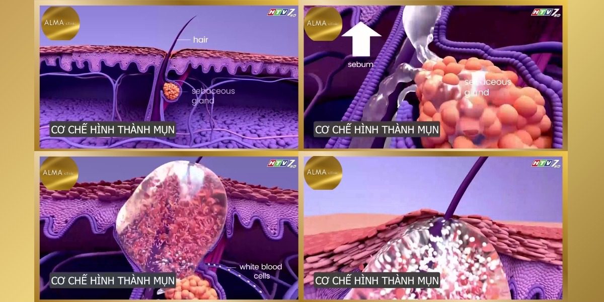 Cơ chế hình thành mụn trứng cá