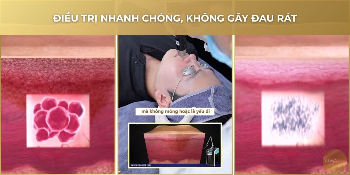 Cơ chế laser trị nám không đau rát