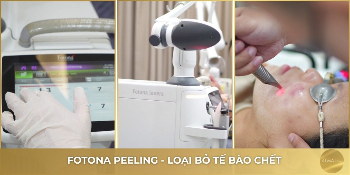 Máy Laser Fotona tại Alma Clinic