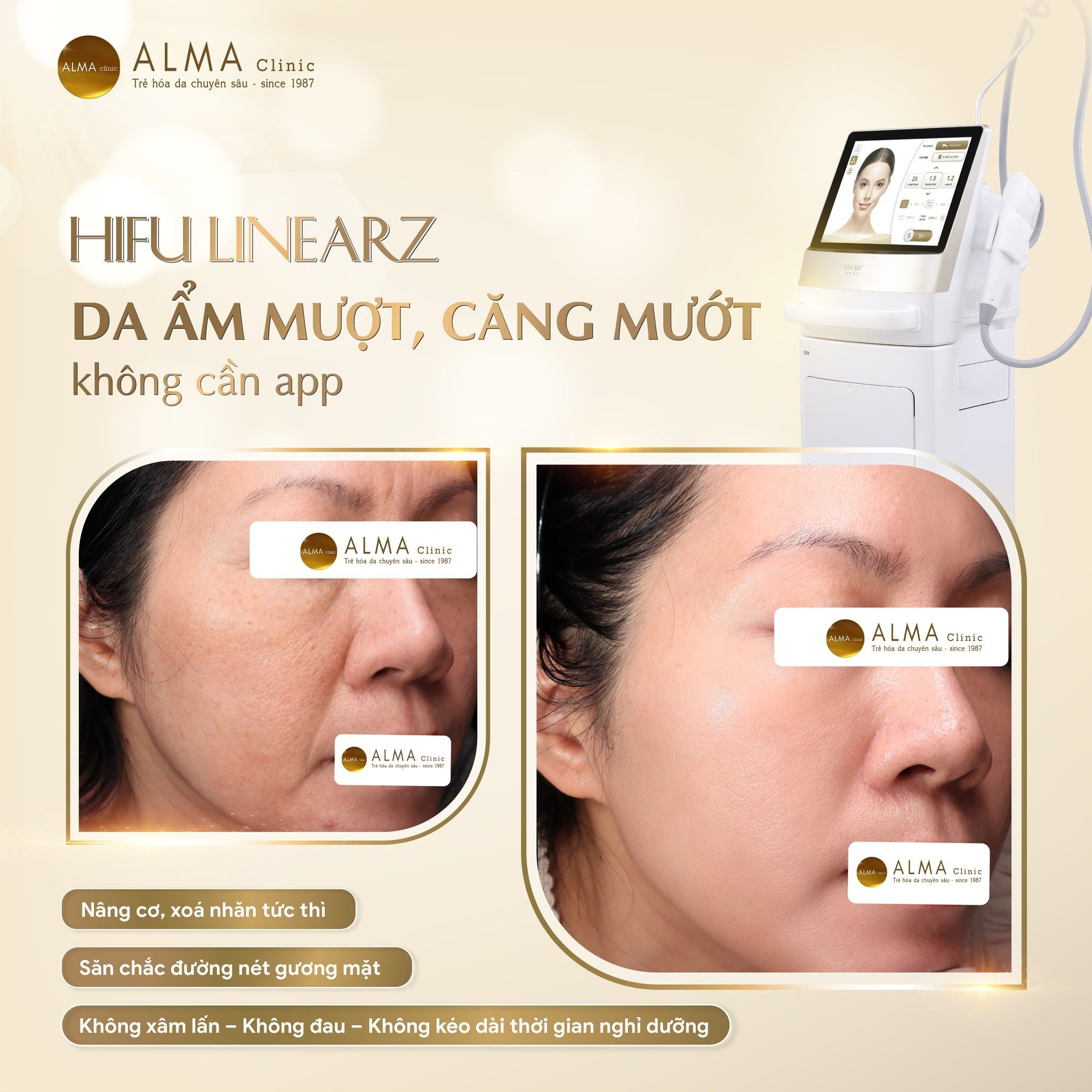 Kết quả trước và sau điều trị nâng cơ HIFU Linear Z