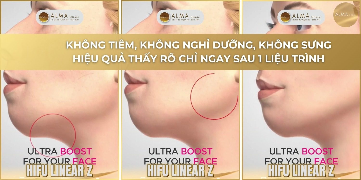 Kết quả công nghệ HIFU Linear Z nâng cơ