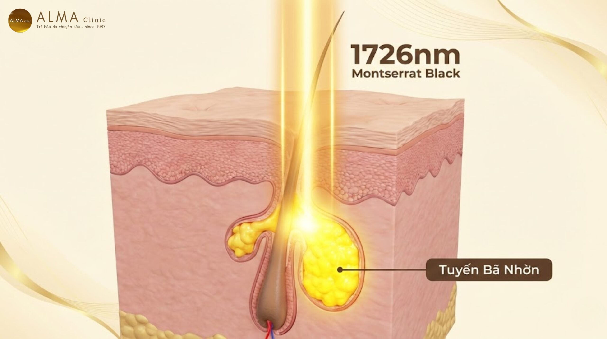 Cơ chế laser 1726nm của AviClear tác động chọn lọc vào tuyến bã nhờn - hình ảnh y khoa 3D